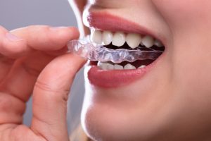 Invisible Aligners Douglasville GA 