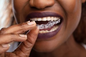 Clear Aligners Naples, FL