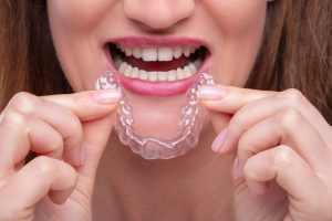 Clear Aligners Dunedin FL